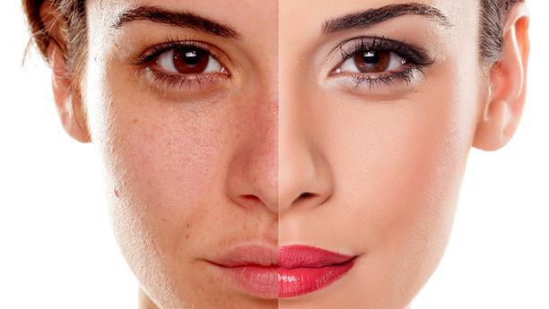 Top 10 kem trị nám tàn nhang đáng mua nhất trên thị trường