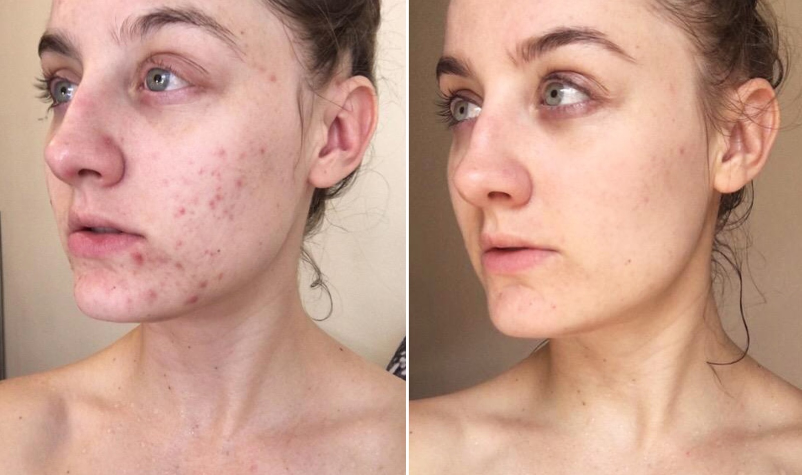 Miếng dán trị mụn cao cấp giúp làn da mịn màng không tì vết